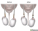 Before and after vasectomy