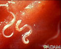 Hookworm - Ancylostoma caninum