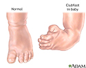 Clubfoot repair - series