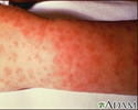 Rocky mountain spotted fever, lesions on arm