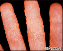 Dermatitis - reaction to tinea