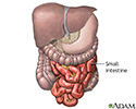 Meckel's diverticulectomy - normal anatomy
