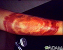 Lyme disease - erythema migrans