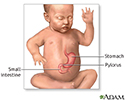 Infantile pyloric stenosis - series