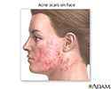 Skin smoothing surgery - series - Indication
