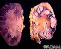 Tuberculosis in the kidney
