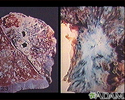 Tuberculosis in the lung