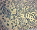 Amebic brain abscess