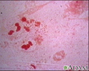 Haemophilus influenza organism