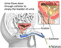 Bladder catheterization - male