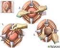 Cesarean section