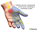 Carpal tunnel syndrome