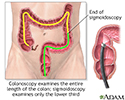 Colonoscopy