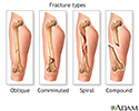Fracture types (1)