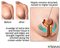 Mammoplasty