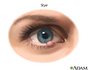 Stye