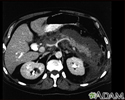 Pancreatitis, acute - CT scan