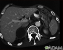 Adrenal metastases - CT scan