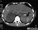 Adrenal Tumor - CT