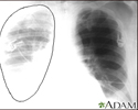 Aortic rupture - chest X-ray