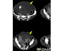Ascites with ovarian cancer - CT scan