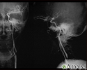 Carotid stenosis - X-ray of the left artery
