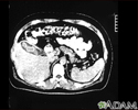 Cholecystitis, CT scan