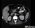 Cholecystolithiasis