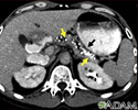 Pancreatitis, chronic - CT scan
