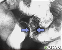 Crohn disease - X-ray