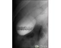 Gallstones, cholangiogram