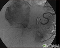 Hemangioma - angiogram