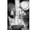 Ileus - X-ray of distended bowel and stomach