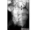 Ileus - X-ray of bowel distension