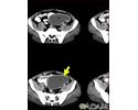 Intra-abdominal abscess - CT scan