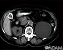 Kidney cyst with gallstones - CT scan
