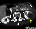 Kidney metastases - CT scan