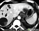 Liver echinococcus - CT scan