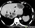 Liver metastases, CT scan