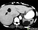 Liver and spleen cysts - CT scan