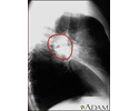 Lung cancer - lateral chest x-ray