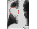 Lung cancer - frontal chest X-ray
