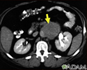 Lymph node metastases, CT scan