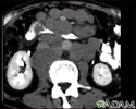Lymphoma, malignant - CT scan