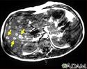 Melanoma of the liver - MRI scan