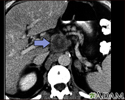 Pancreatic cancer, CT scan