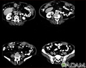 Peritoneal and ovarian cancer, CT scan