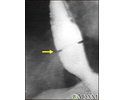 Schatzki ring - x-ray