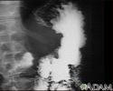 Stomach cancer, X-ray