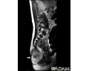 Teratoma - MRI scan
